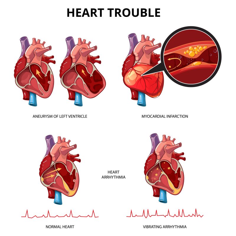 cardiomiopatia