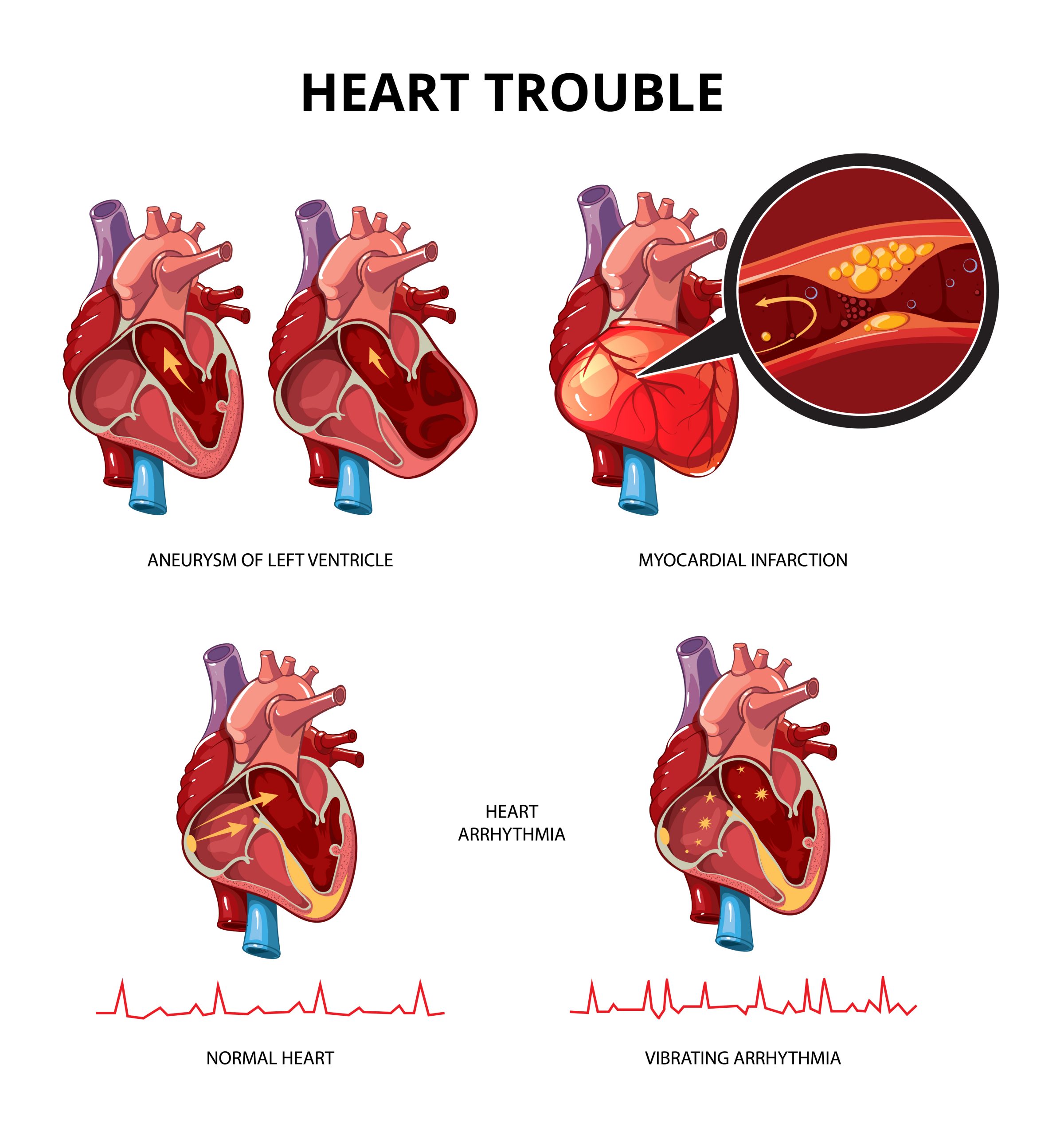 cardiomiopatia